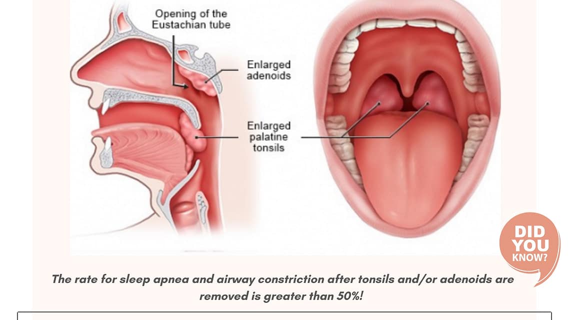 Tonsil Removal and Myofunctional Therapy