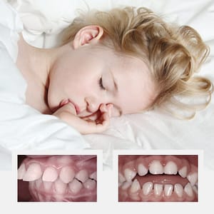 Thumbsucking Causes Problems in Dental Development