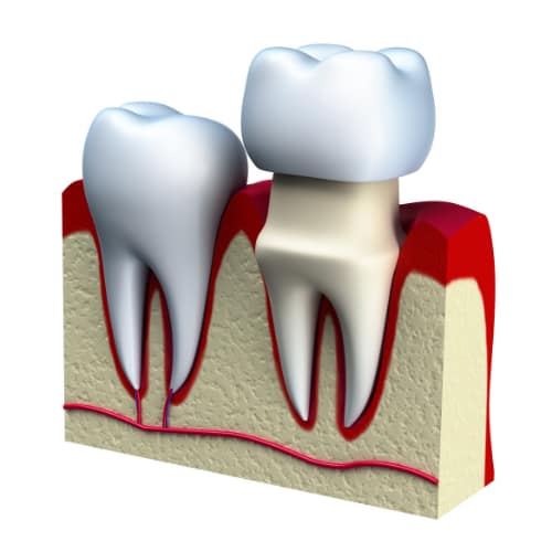 Crowns Family Dental Centre Guelph