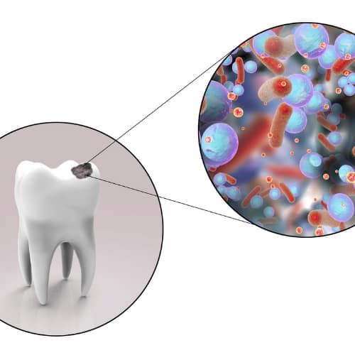 What Is Tooth Decay Family Dental Centre Guelph