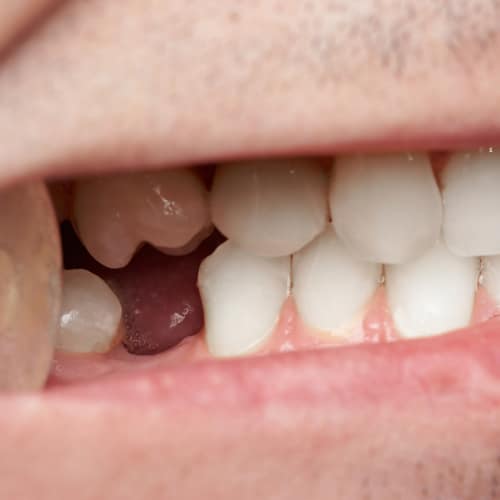 Missing Teeth Family Dental Guelph