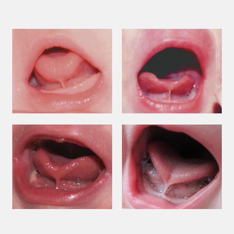 6 Tips to Prevent Mouth Breathing in Infants and Children